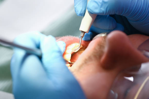 Best Emergency Dental Extractions in Blacksburg, VA
